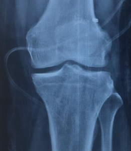 ACL reconstruction bio screws