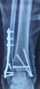 Complex ankle fracture fixed well