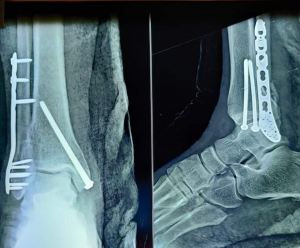 Ankle fracture fixed with plates and screws