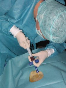 doctor aspirating bone marrow from a patient