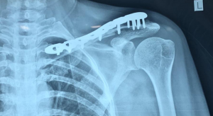 Collar bone fracture fixed with plate and screws