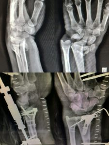 Fracture of distal radius complex fracture treated with plates screws and wires
