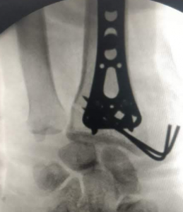 wrist fracture restored well