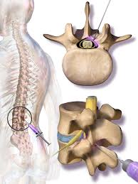 lumbar spine intervention