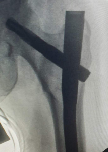 Hip fracture back to normal