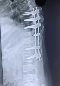 Tuberculosis of spine recovered