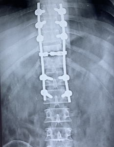 tuberculosis of spine recovered