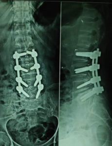 Spinal Fusion surgery 4 levels