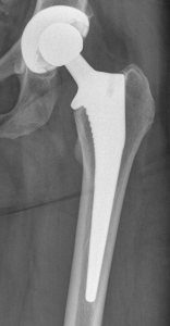Total hip replacement cup and stem