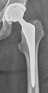 Total hip replacement back to normal