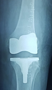 total knee replacement